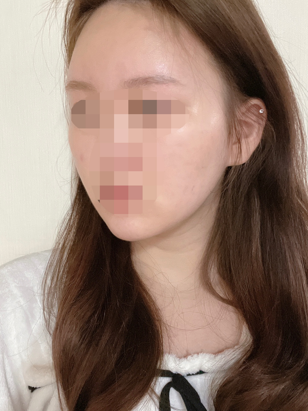 수술후기이미지