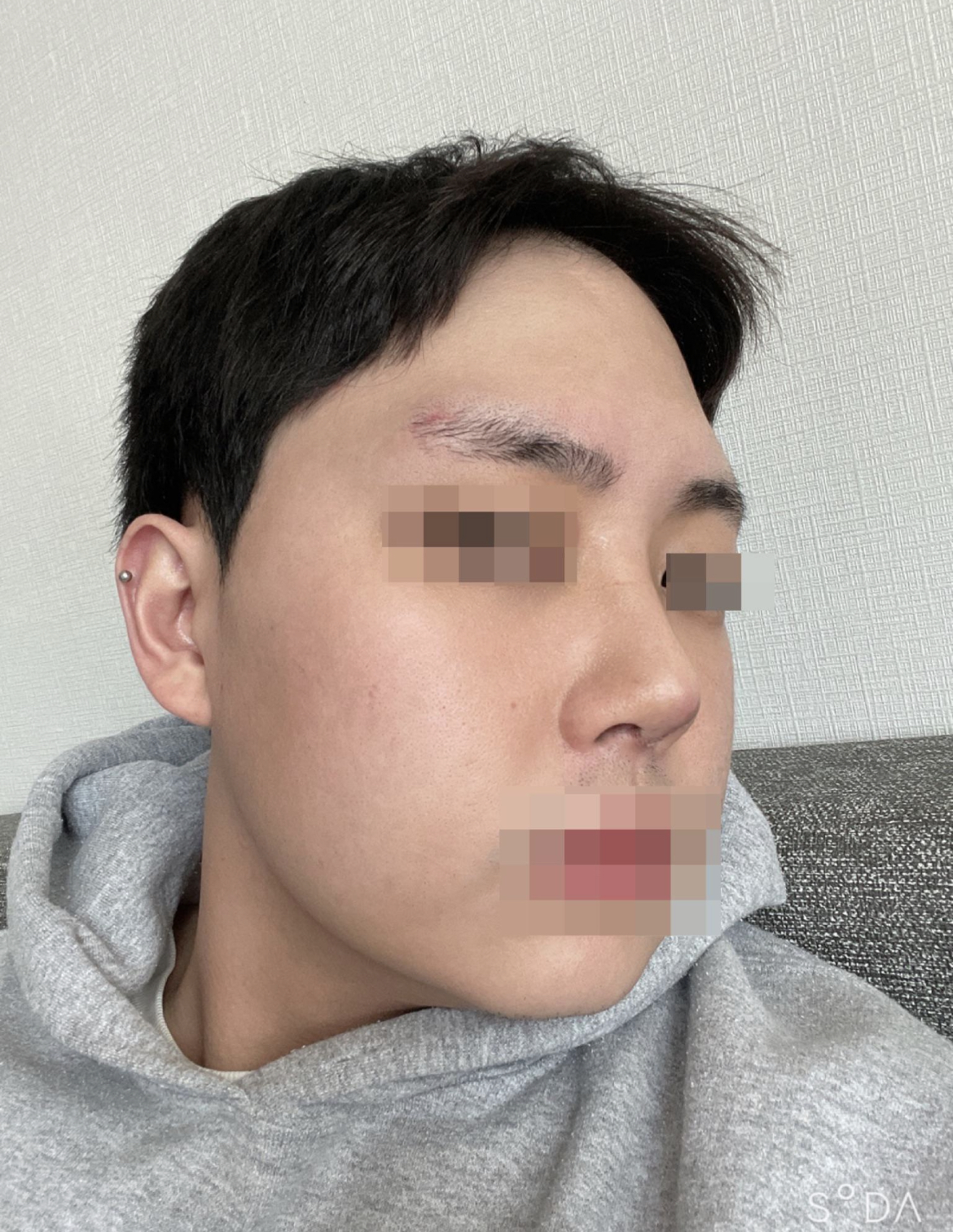 수술후기이미지