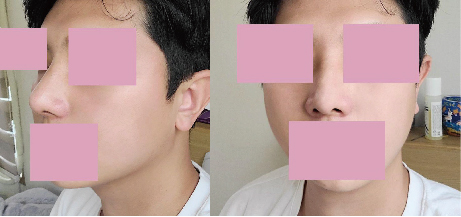 수술후기이미지