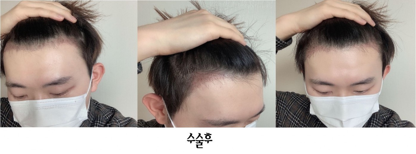모발이식 한달차입니당