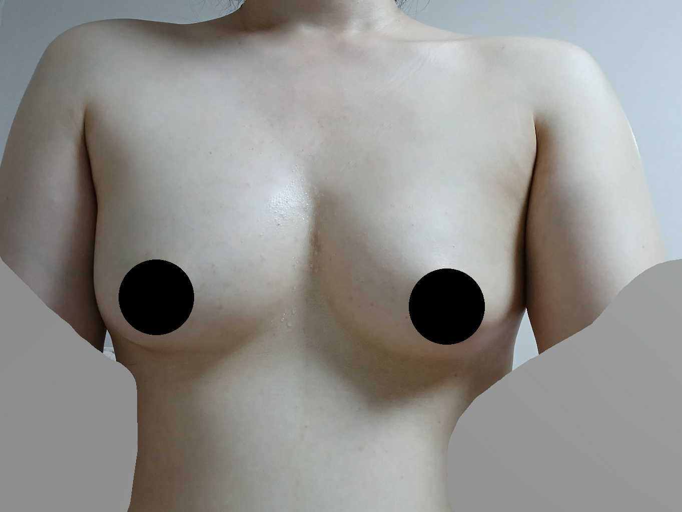 수술후기이미지