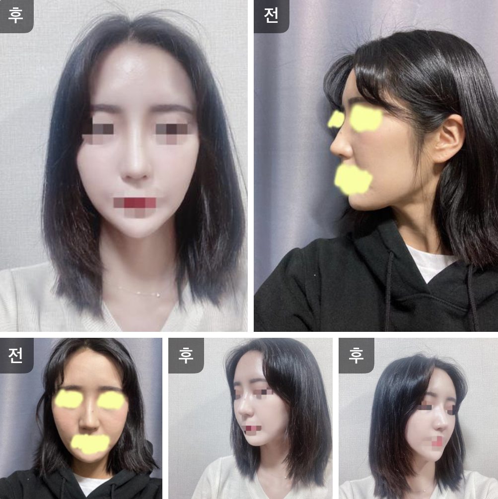 수술후기이미지