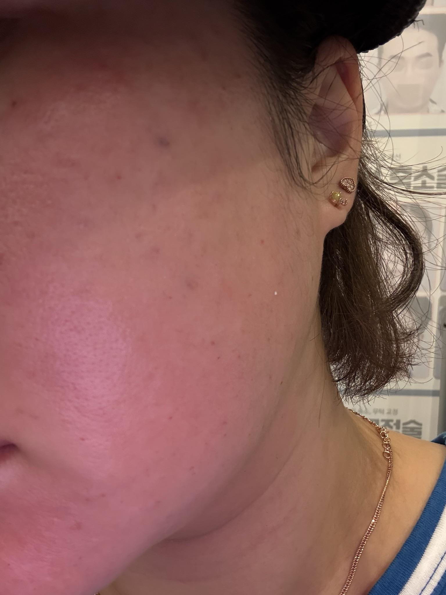 수술후기이미지