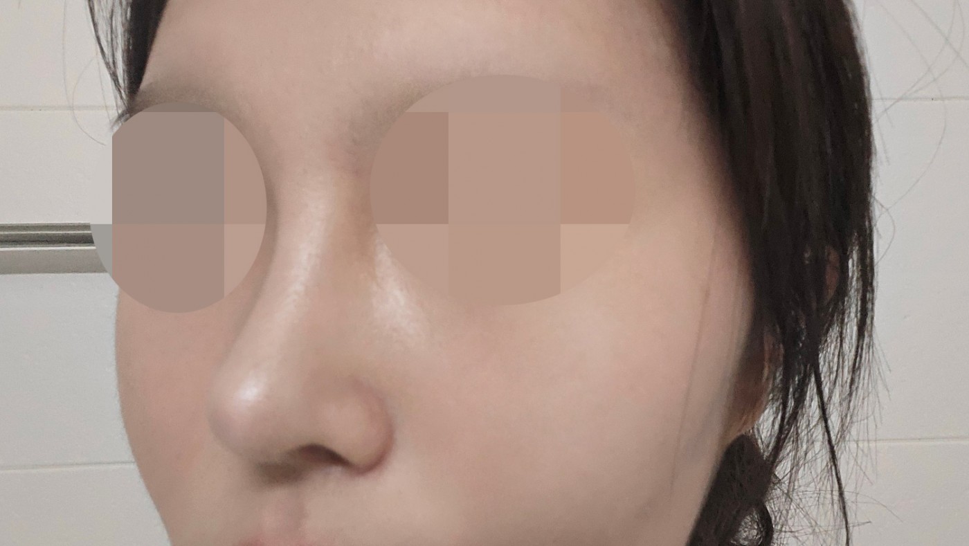 수술후기이미지