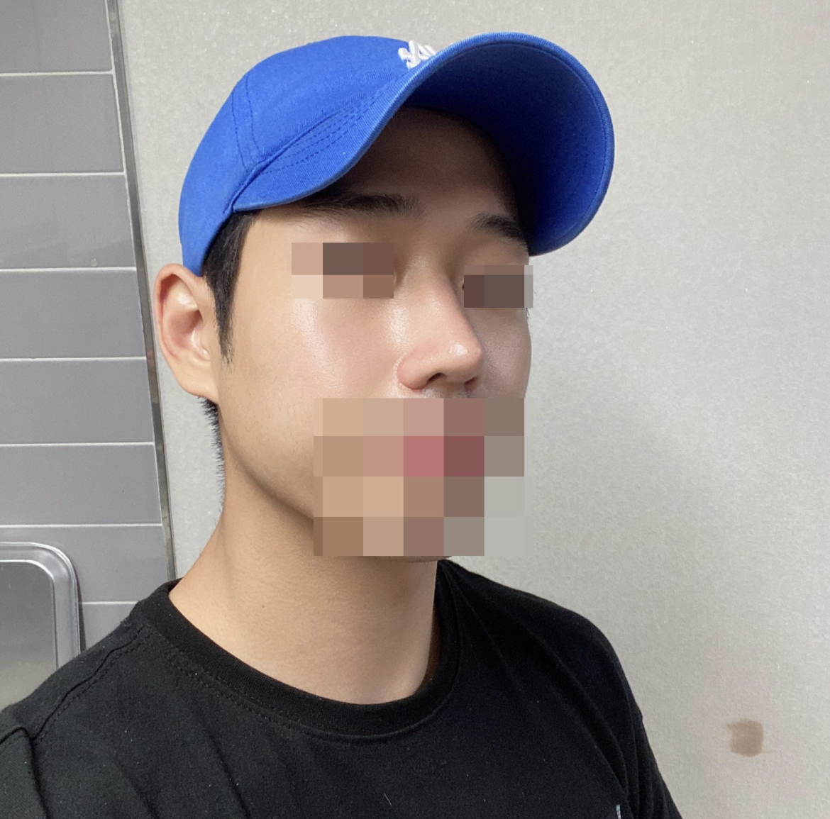 수술후기이미지