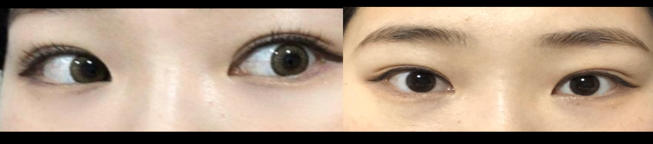 수술후기이미지