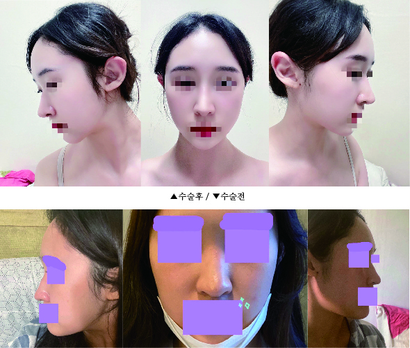 수술후기이미지