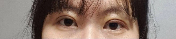 수술후기이미지