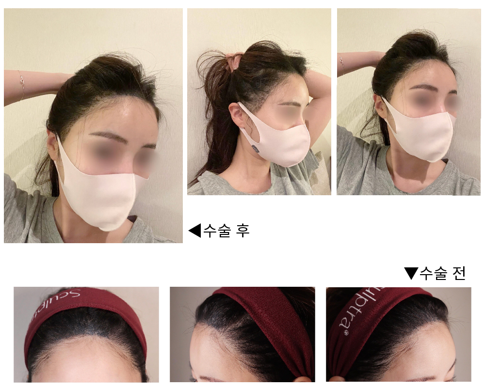 헤어라인 비절개 모발이식했어요