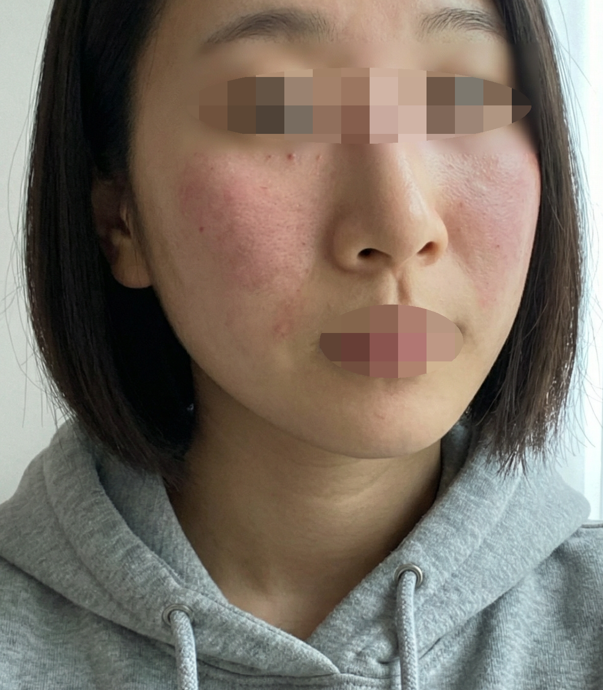 수술후기이미지